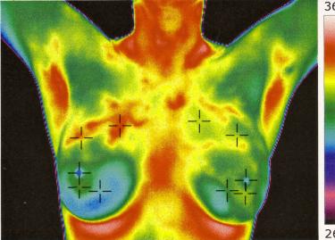 Thermography--The-Science-of-Breast-Screening1-kitchener-tvfc1
