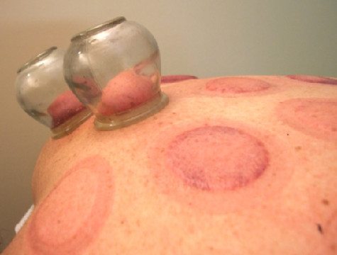 Dry cupping; a partial vacuum is created in the glass cup, drawing up the skin, and rupturing blood vessels to cause a bruise.
