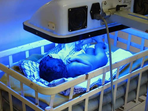 phototherapy for jaundice babies