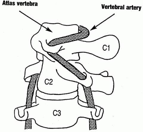 vertebral dissection