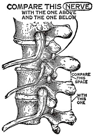 An old Palmer illustration showing how a displaced vertebra could cause disease by pinching a spinal nerve.