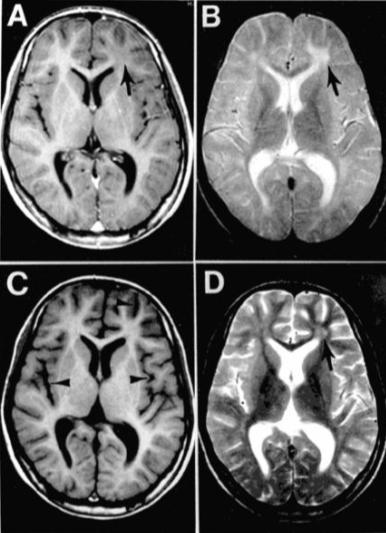 From the PMC 2640885, "Subacute sclerosing panencephalitis, a measles complication, in an internationally adopted child", via the Wikimedia commons.  Initial and three-month presentation of a thirteen-year-old adopted child with SSPE.