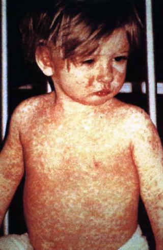 From the CDC Public Health Image Library #132 via the Wikimedia commons.  Child with classic measles day-four rash.