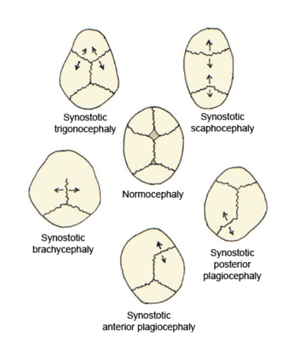 single-sutuer-synostosis