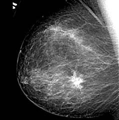 Breast cancer on mammography
