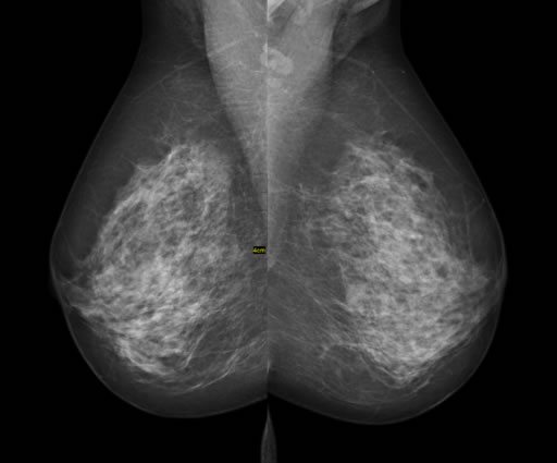 Screening mammography