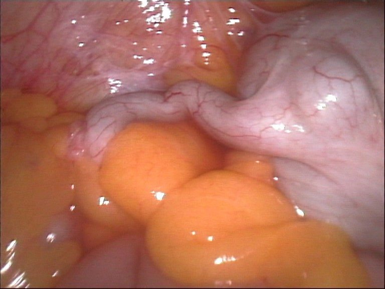 An appendix, mid-appendectomy.