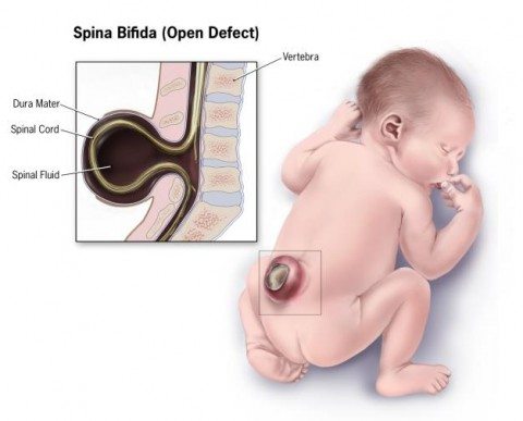Spina bifida, one of the consequences of insufficient folic acid.