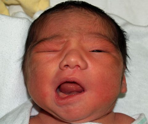 An infant with a left facial nerve palsy