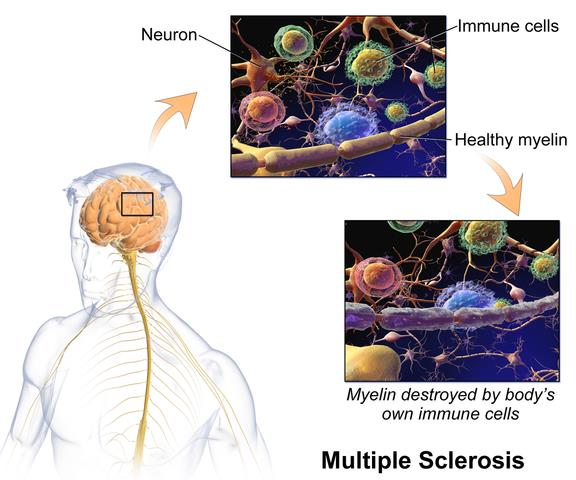 The scientifically-accepted mechanism by which multiple sclerosis causes symptoms
