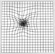 Macular degeneration distorts the center of an Amsler grid