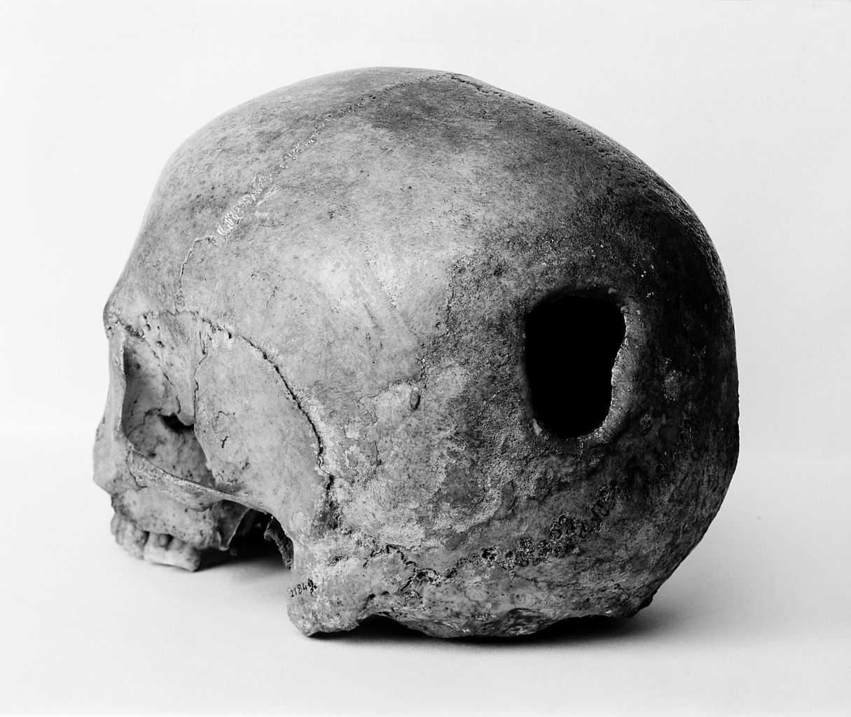 A trepanation hole, a prehistoric treatment for mental illness still used by some who should know better, today.
