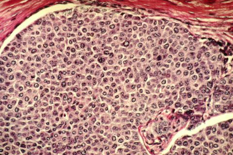 Cancer quackery: Under MAHA, everything old is new again