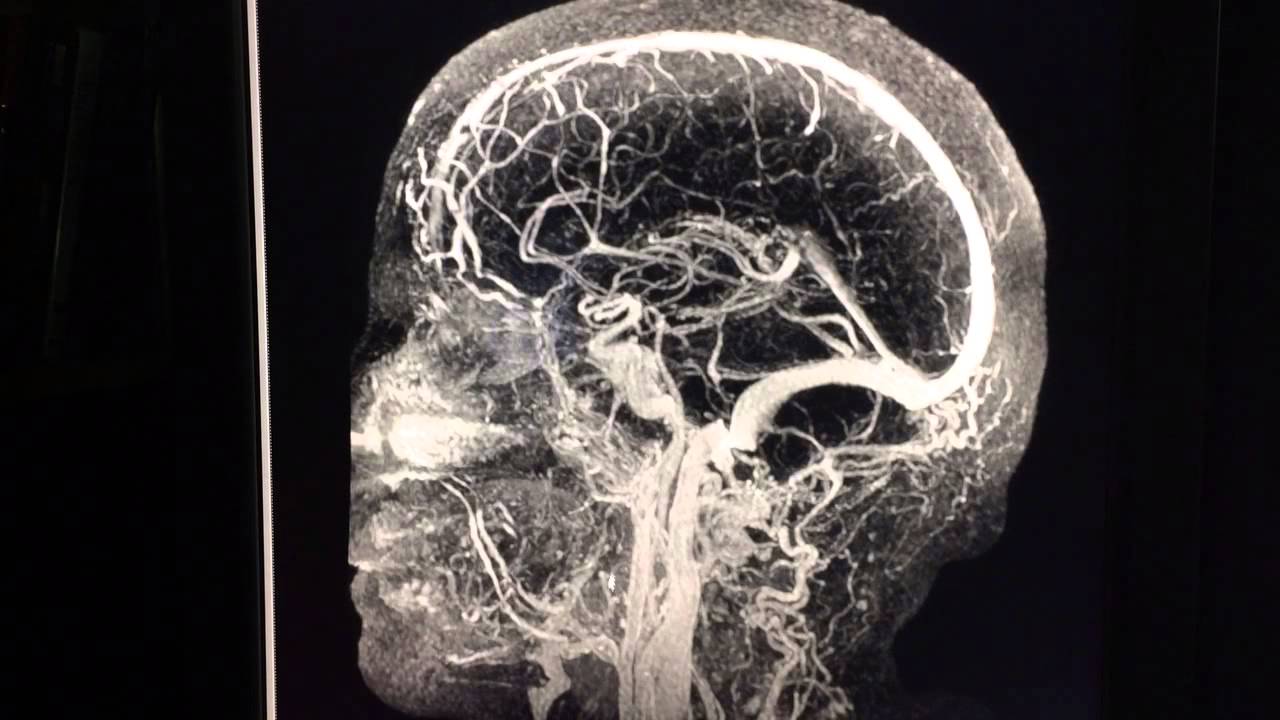 Сосуды головного мозга норма. МРА (магнитно-резонансная ангиография). МР-ангиография сосудов головного мозга. Мрт головного мозга с ангиографией. Времяпролетная ангиография.