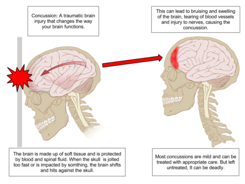 Chiropractor Treating Concussions For Earlier Return To Play | Science ...