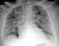 pneumonia radiology infiltrates xray cxr radiopaedia aspiration radiographic verywellhealth despatches officially interstitial fluffy