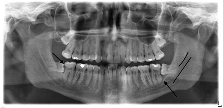 The Wisdom of Third Molar Removal | Science-Based Medicine