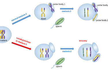 Example of trisomy