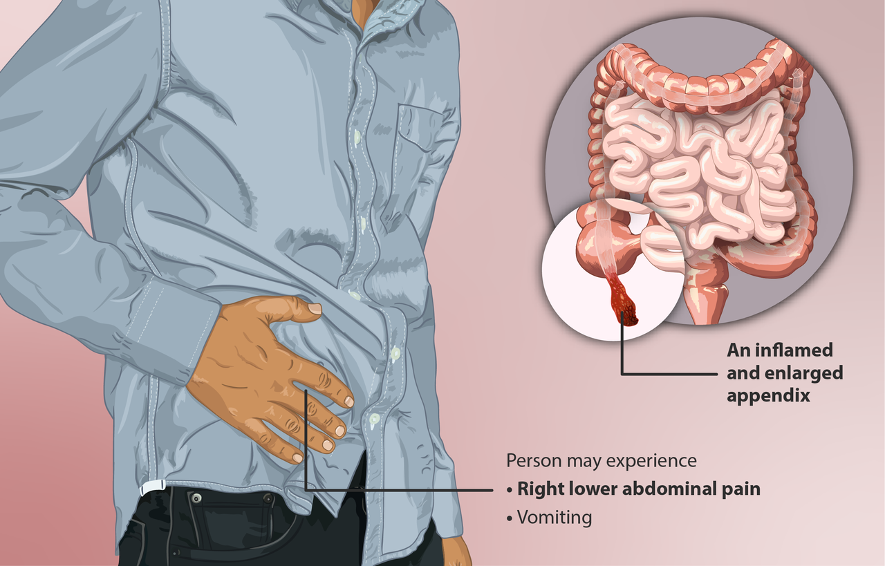 Why Can T You Eat After Appendix Surgery