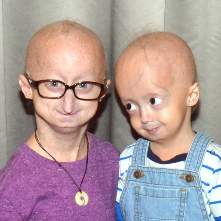 progeria syndrome babies