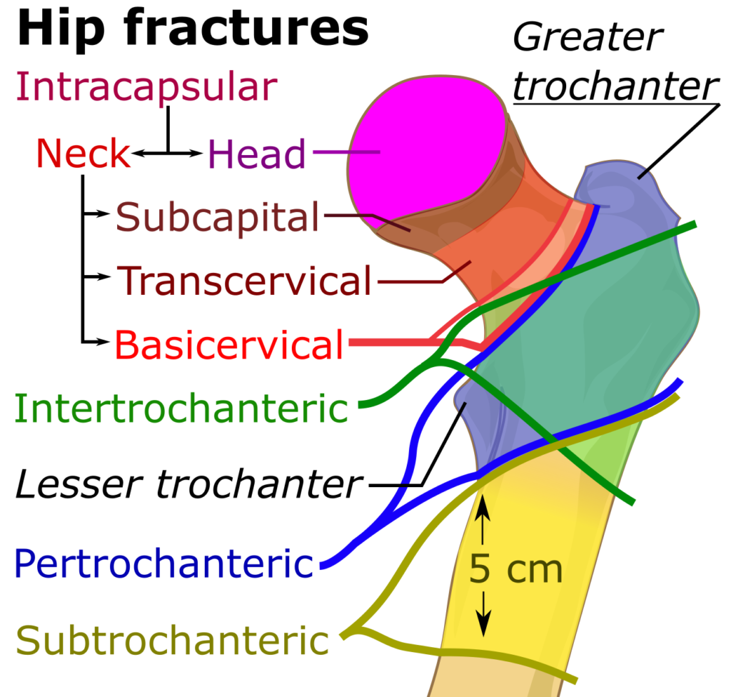 Ao Hip Fracture Classification