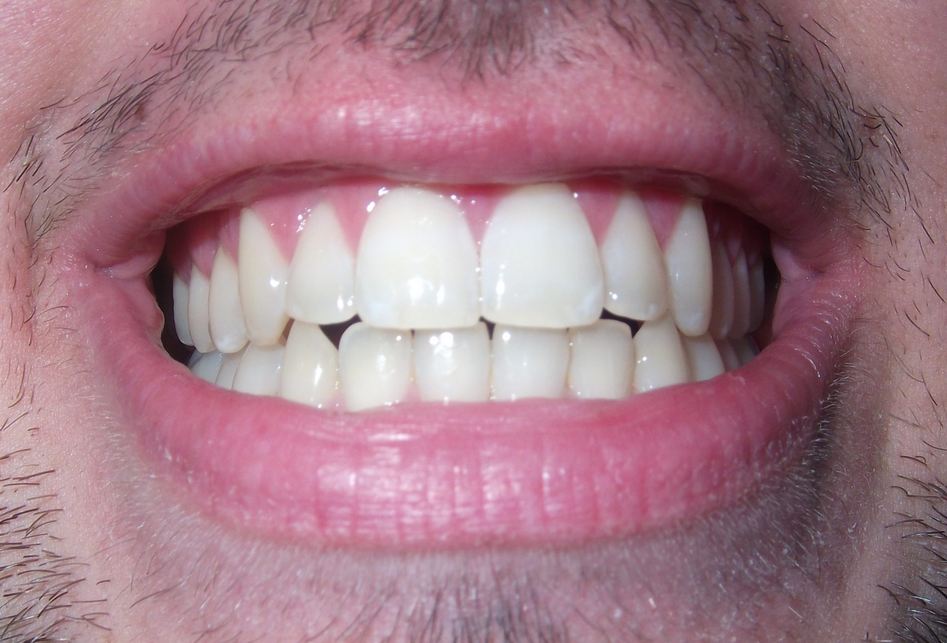 Do You Need Daily Treatment to Repair Damaged Enamel?