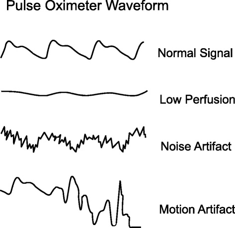 Pulse oximetry waveforms