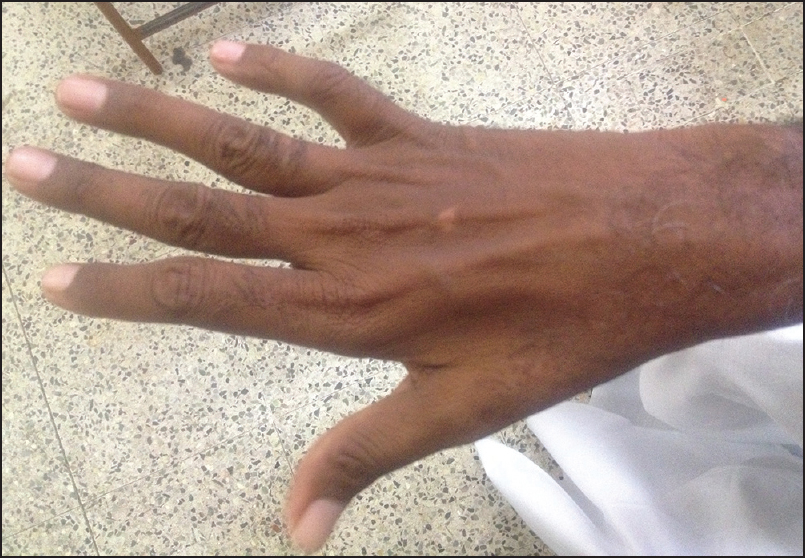 0 News Article Image La FDA approuve le médicament controversé contre la SLA - Relyvrio