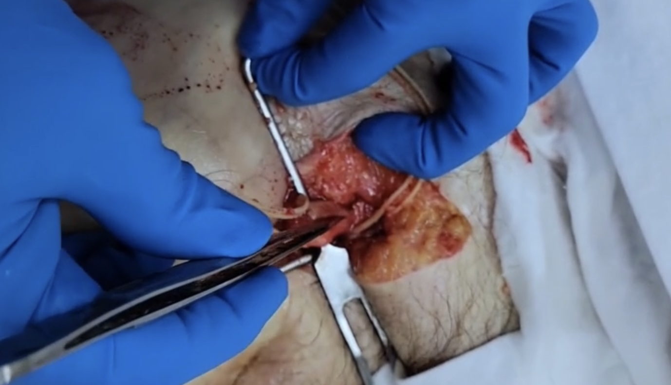Removal of a clot from the iliac artery.