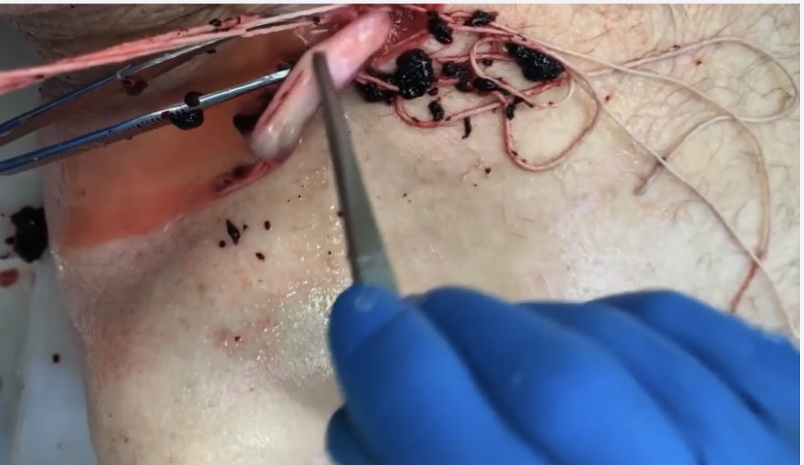 Clot extraction