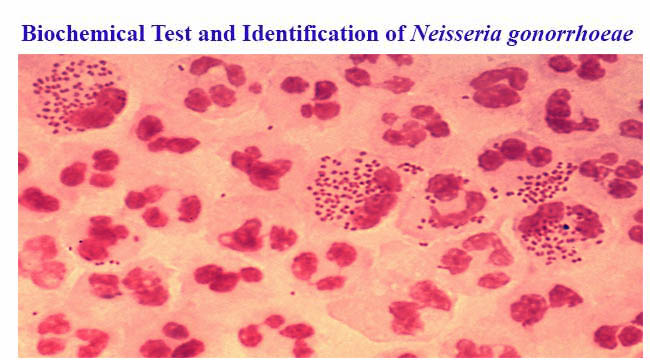 There is really nothing super about Antibiotic Resistant Gonorrhea ...