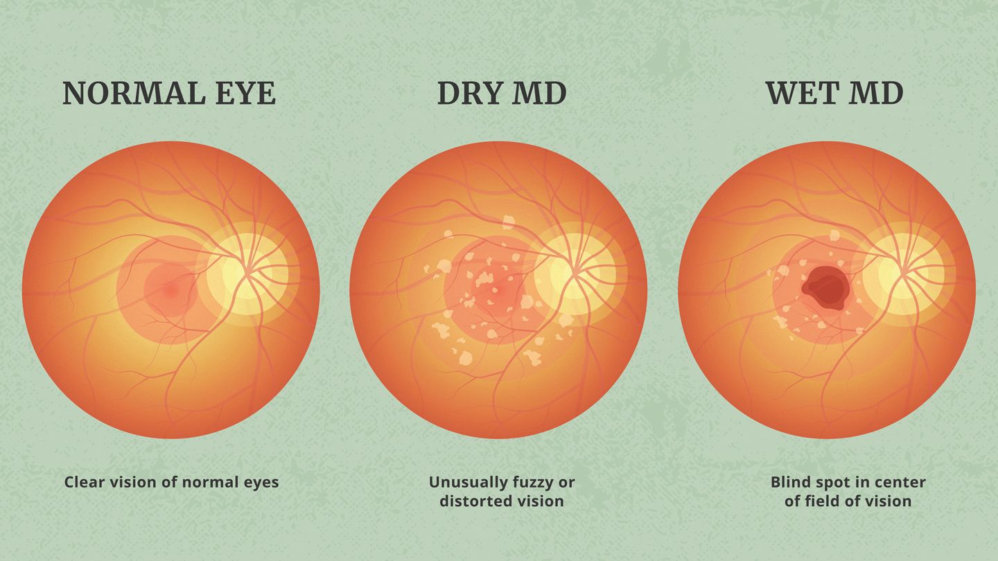 Pegcetacoplan (Syfovre™) for macular degeneration: an update | Science