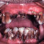 A close-up image showing severe dental decay. Multiple teeth are discolored, significantly decayed, and broken. The gums appear inflamed and red, indicating possible severe infection and poor oral hygiene.