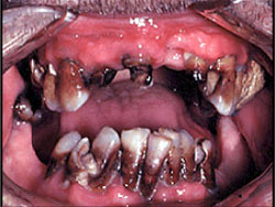 A close-up image showing severe dental decay. Multiple teeth are discolored, significantly decayed, and broken. The gums appear inflamed and red, indicating possible severe infection and poor oral hygiene.