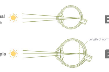 Diagram comparing normal eye and myopia (nearsightedness). The image shows light rays properly focusing on the retina in a normal eye, while in a myopic eye, light rays focus before the retina, causing distant objects to appear blurry.