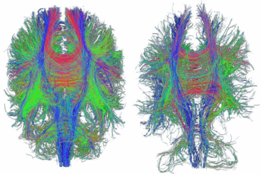 Two colorful brain scans showing neural pathways; lines in red, green, and blue trace intricate fiber connections across the left and right hemispheres, representing brain connectivity in two different individuals or conditions.