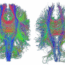 Two colorful brain scans showing neural pathways; lines in red, green, and blue trace intricate fiber connections across the left and right hemispheres, representing brain connectivity in two different individuals or conditions.