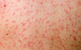 Measles rash