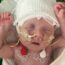A newborn baby lies on a hospital bed with arms raised, wearing a white knit hat and connected to medical tubes and sensors. The baby is covered with a blanket, and part of a colorful caterpillar design is visible nearby.
