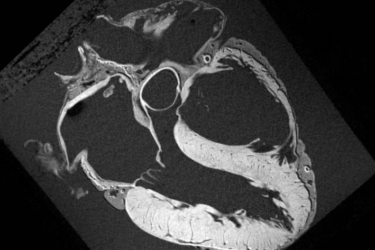 Black and white cross-sectional medical image (MRI or CT scan) showing detailed structures of the human heart, including chambers and surrounding tissues, viewed from above.