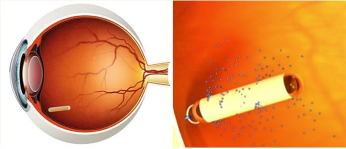 A cross-section of an eye shows a small implant inside it; a close-up on the right illustrates the implant releasing tiny particles or medication into the surrounding tissue.