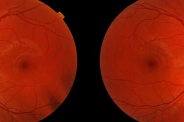 Close-up images of the retinas of two human eyes, showing blood vessels radiating from the optic discs with a reddish-orange background.