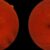 Close-up images of the retinas of two human eyes, showing blood vessels radiating from the optic discs with a reddish-orange background.