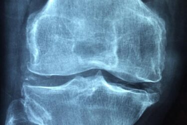 X-ray image showing a detailed front view of a human knee joint, including the femur, tibia, and gap of the joint space. The bones appear intact, with clear outlines visible.