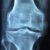 X-ray image showing a detailed front view of a human knee joint, including the femur, tibia, and gap of the joint space. The bones appear intact, with clear outlines visible.