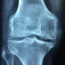 X-ray image showing a detailed front view of a human knee joint, including the femur, tibia, and gap of the joint space. The bones appear intact, with clear outlines visible.