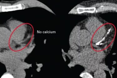 Side-by-side CT scan images of a heart; the left shows no calcium in the circled area, while the right highlights visible calcium deposits in the LAD and D1 arteries, both circles marked in red.