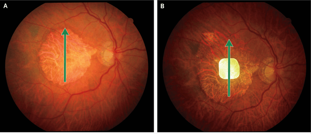 Side-by-side retinal images labeled A and B, each showing a green arrow pointing upward toward a yellowish, irregular lesion in the central retina. Image B has a bright white spot over the lesion.