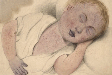 A drawing of a sleeping child with short blond hair, covered in red spots and a rash, wearing a white shirt and resting their head on one hand. The child appears to be unwell.