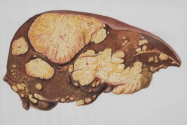 A detailed illustration of a human liver with multiple large, irregular yellowish masses indicating severe fatty infiltration or disease, against a plain white background.